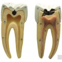 DENTAL CARIES MODEL